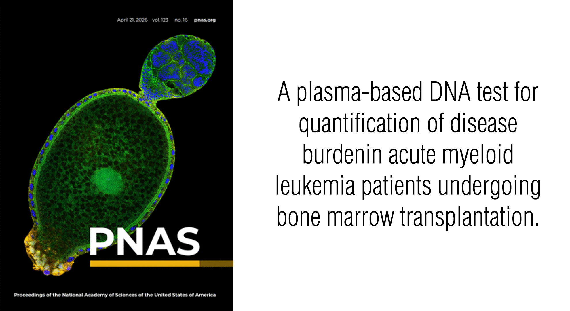 A plasma-based DNA test for quantification of disease burdenin acute myeloid leukemia patients undergoing bone marrow transplantation.&nbsp;